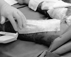Fig. 3Application of Hyalomatrix.