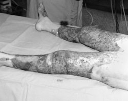 Fig. 4The wounds (ready for grafting) after removal of Hyalomatrix.