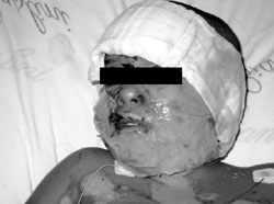 Fig. 5Greeny colour of wounds due to jellified Hyalomatrix.