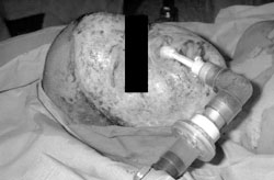 Fig. 6Third-degree flame burns on face (same patient as in Fig. 5).