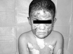Fig. 7The patient on the way towards healing (her complexion was olive).
