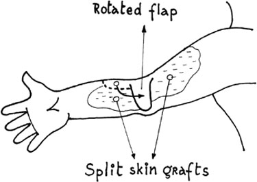 Fig. 1Scheme for the surgical approach of operative treatment of burn wound in the elbow fold area.