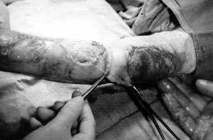 Fig. 2Rotated flap from the forearm.