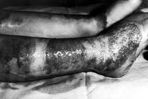 Fig. 4Burn wound in the lower extremity.