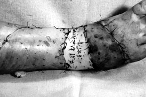Fig. 5Full-thickness skin applied to the fold and split-skin grafting on the next layers.