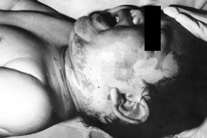 Fig. 7Seven-month-old girl with second-degree scald burns in the mandibular region.