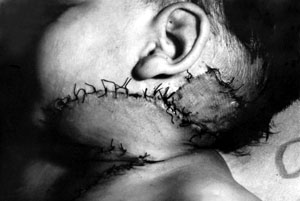 Fig. 8Rotation flap from the chest wall under the ear and split-skin grafting behind it.