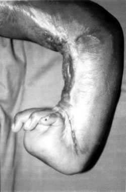 Fig. 2aPost-burn dorsal hand contracture.