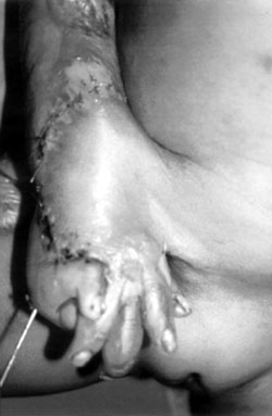 Fig. 2bPreparation of distance pedicle abdominal flap.