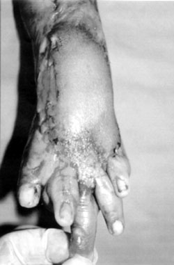 Fig. 2cRelease of contracture and coverage of raw area with abdominal pedicle flap.