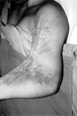 Fig. 3aPost-burn contracture of anteromedial surface of left forearm.