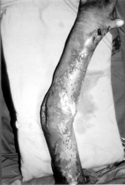 Fig. 3bRelease of contracture and coverage of raw area with Z-plasty and split-thickness skin graft.