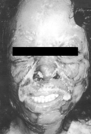 Fig. 4Young female burned with sulphuric acid. The patient was subjected to various surgical treatments: Z-plasty for oral commissures and nostril contracture, and multiple skin grafts for eyelid contracture.