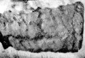 Fig. 2Split-skin donor site with razor-thick skin coverage.