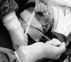 Fig. 3Razor-thick scalp skin harvesting with scalp haemostatic band.