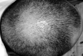 Fig. 4Razor-thick scalp skin donor site healed after skin harvesting.