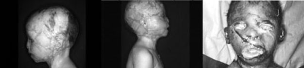 Fig. 2The patient on admission and after amputation of the pinnae and repair with free skin grafts.