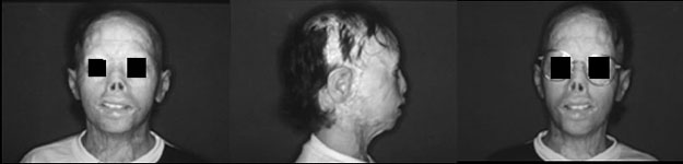 Fig. 3Same patient, at age of 9 years, after application of auricular epistheses to enable him to wear glasses.