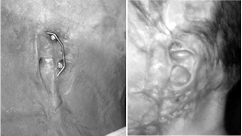 Fig. 4Detail of left auricular region. Lower figure shows gold bar, attached to the fixtures, onto which the episthesis is to be fixed.