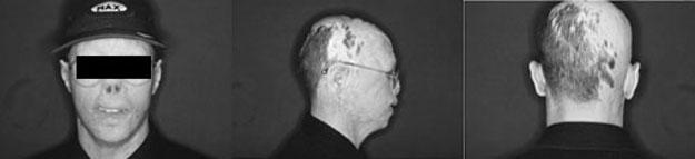 Fig. 5Patient at age of 14 years after further corrective operations.