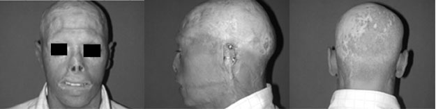 Fig. 6Patient, now aged 23 years. He has changed his epistheses twice because they had to be altered in size in relation to his physical growth and because with the passing of time they became discoloured.