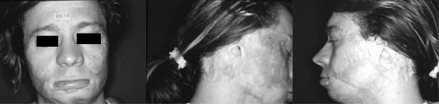 Fig. 7The patient on admission. Notice the ample scarring in the auricular regions.