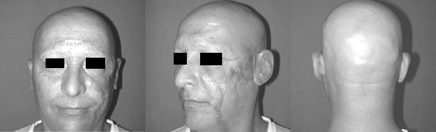 Fig. 10After application of the left auricular episthesis.