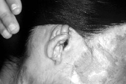 Fig. 11The right pinna as it appeared when the patient was admitted.