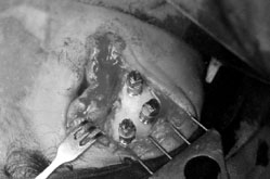 Fig. 12The phase of positioning the abutments.