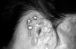 Fig. 13The gold bar fixed to the abutments.