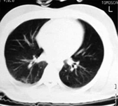 Fig. 1aMany small scattered lesions, the largest being located in the posterior part of the right middle lobe, and small bilateral pleural effusion.