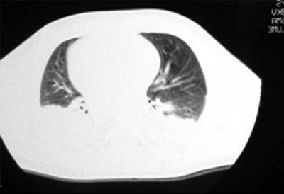Fig. 1bNormal chest radiograph.