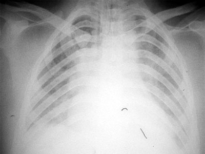Fig. 2aCT scan shows bilateral pleural effusion and pulmonary infiltrates and atelectasis at both bases.
