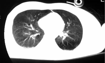 Fig. 2bDifficult chest radiograph evaluation owing to soft tissue oedema.