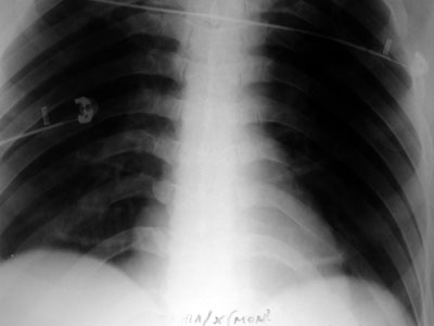 Fig. 3aSmall consolidation at right base with bilateral pleural effusion and asymmetrical expansion of both lungs.