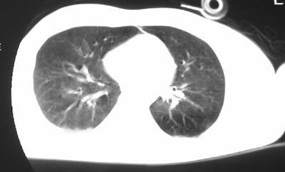 Fig. 3bThe contrary chest radiograph looks almost normal.