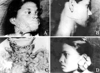 Fig. 1Figs. 1a,b - Post-burn hypertrophic scars.  Fig. 1c - Post-burn keloid. Fig. 1d - Earlobe keloid.