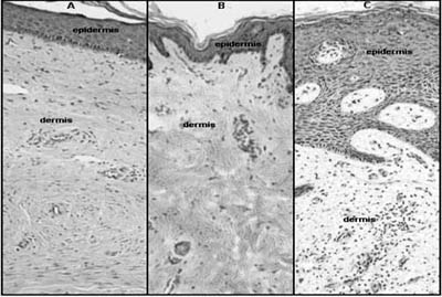 Fig. 2Haematoxylin and eosin staining of paraffin-embedded sections of keloid (A), normal skin (B), and hypertrophic scar (C).