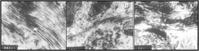 Fig. 3Electron microscopy images of tissue sections of keloid (A), normal skin (B), and hypertrophic scar (C). Collagen fibres are indicated by arrow.
