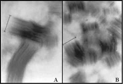 Fig. 4Segment-long-spacing analysis by electron microscopy of pepsin-soluble collagen extracted from normal skin (A) and keloid (B). Sizes of cross-linked fibres are indicated.