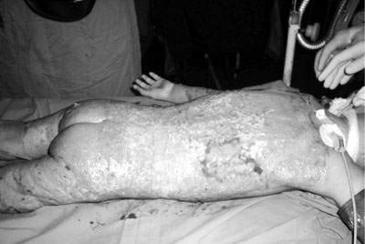 Fig. 1Child burned with hot water.