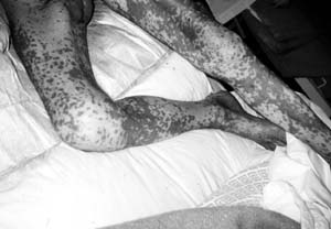 Fig. 2Patient suffering from Stevens-Johnson syndrome.