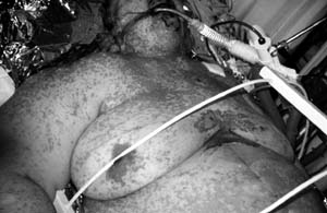 Fig. 4Patient suffering from Lyell�s syndrome.