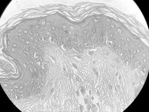 Fig. 2Compared to skin from a healthy young donor, the integument was characterized by atrophy. The stratum corneum was a little altered in thickness, and there was a reduction in the dermoepidermal papillae. There was also a reduction in the number of melanocytes and Langerhans cells. The most significant cutaneous changes were seen in the dermis, especially in the superficial layers. The elastic fibres, which are responsible for maintaining collagen orientation, physiological recoil, and laxity, underwent intrinsic degenerative changes. Dermal collagen, which accounts for 70 to 80% of the skin�s dry weight, also decreases with ageing. Much of this loss occurs in the reticular dermis