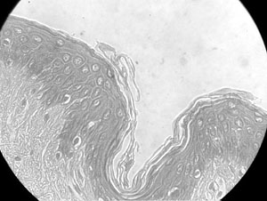 Fig. 4Well-differentiated cells that gradually increase in size. Note increased acanthosis compared to previous samples