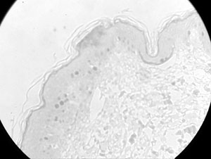 Fig. 8Ki-67 was detected in a few keratinocytes, mostly in the parabasal layers but rarely in the basal layers