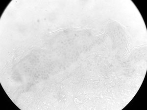 Fig. 10P63 expression in old normal skin - it was expressed in a small proportion of suprabasal cells