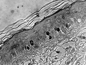 Fig. 12The proportion of cells expressing ki-67 antigen decreased, concomitantly with progressive degeneration of the epithelium
