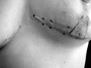 Fig. 23Patient no. 4, one year post-operation (breast red), RFs (thyreopathy, smoking)