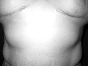 Fig. 24Patient no. 5, 8 months post-operation (breast red), RFs (thyreopathy, hypercholesterolaemia)